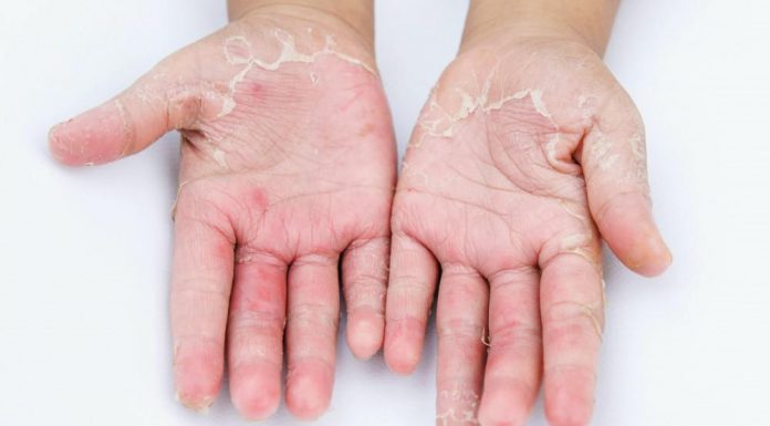 Dermatita: tipuri, tratamente, cauze si simptome