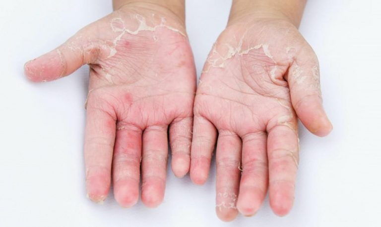 DERMATITA