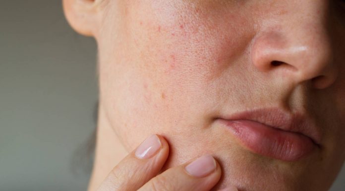 Hipersensibilitatea pielii