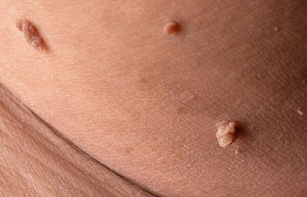 13 remedii casnice pentru negi