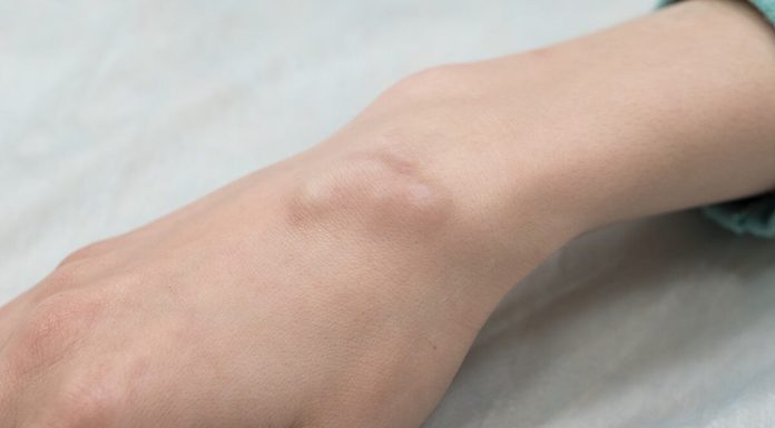 Care este diferenta dintre un chist si o tumoare?