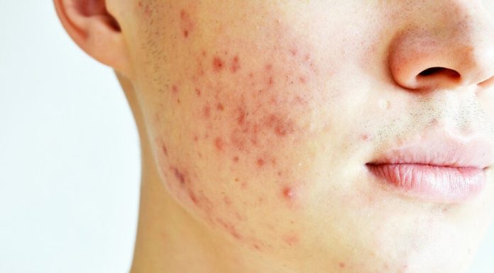 Ce este acneea chistica?