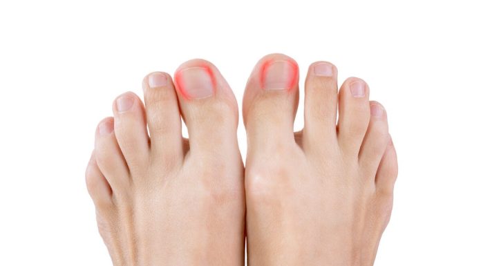Cum sa identifici daca ai ciuperca la picior