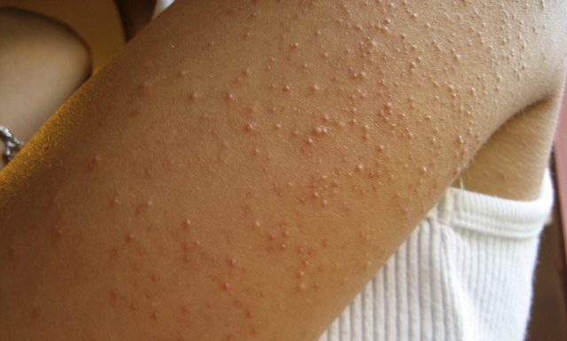 10 semne de intoleranta la gluten