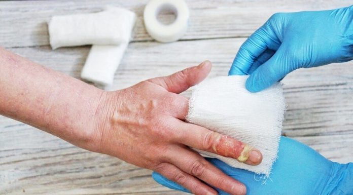 Primul ajutor pentru arsuri cu apa fierbinte