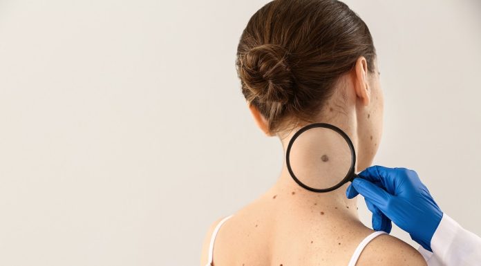 Care sunt semnele unei alunite canceroase?